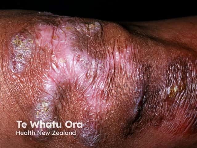 Инфекция Mycobacterium marinum