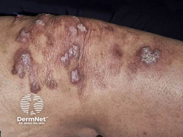 Инфекция Mycobacterium marinum