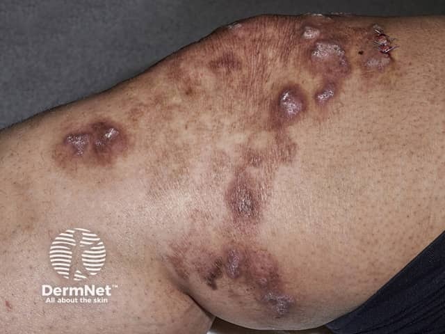 Инфекция Mycobacterium marinum