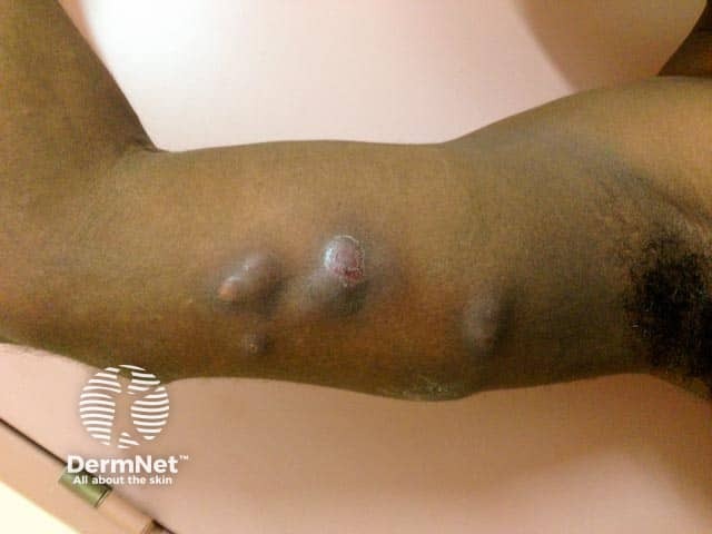 Инфекция Mycobacterium ulcerans на руке