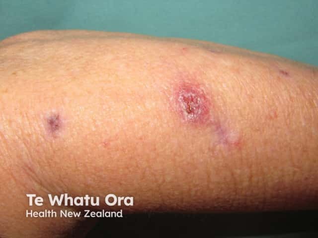 Инфекция Mycobacterium abscessus