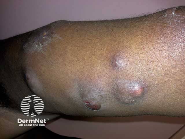 Инфекция Mycobacterium ulcerans на руке