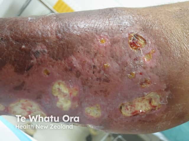 Инфекция Mycobacterium chelonae