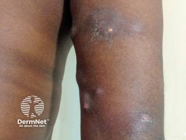 Инфекция Mycobacterium ulcerans на руке
