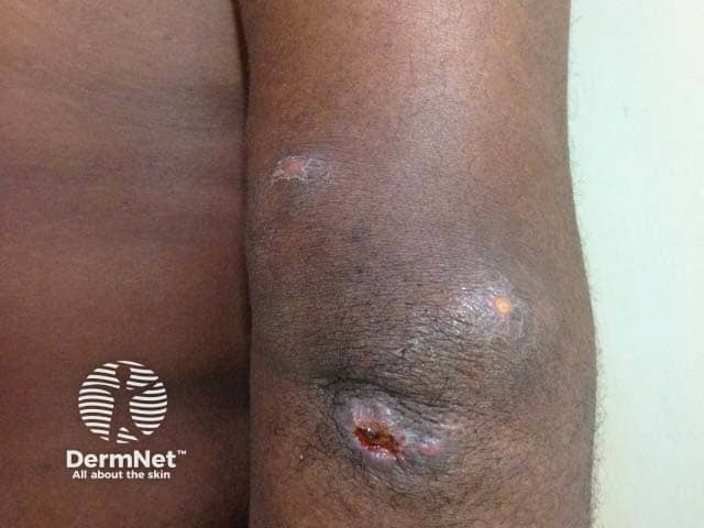 Инфекция Mycobacterium ulcerans на руке