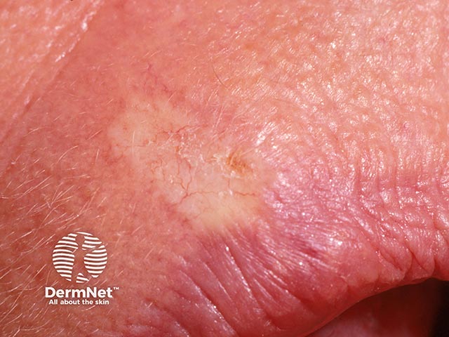 Морфеаподобный базальноклеточный рак губы: ветвящиеся телеангиэктазии в пределах рубцовоподобного очага