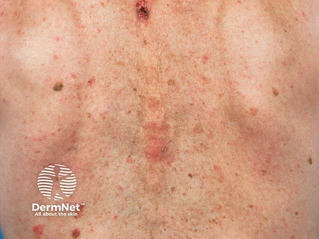 Множественные поверхностные базалиомы после лучевой терапии позвоночника