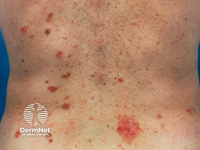 Множественные поверхностные базалиомы после лучевой терапии позвоночника