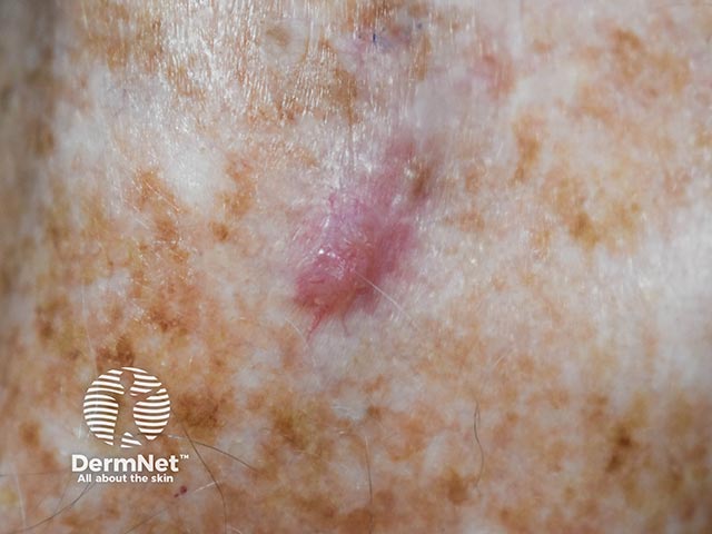 Небольшой базальноклеточный рак на коже с признаками фотоповреждения
