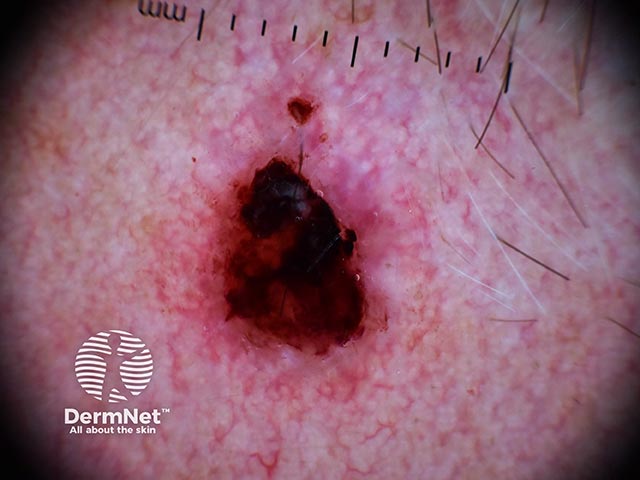 Засохшие кровянистые корки маскируют дерматоскопические критерии диагноза