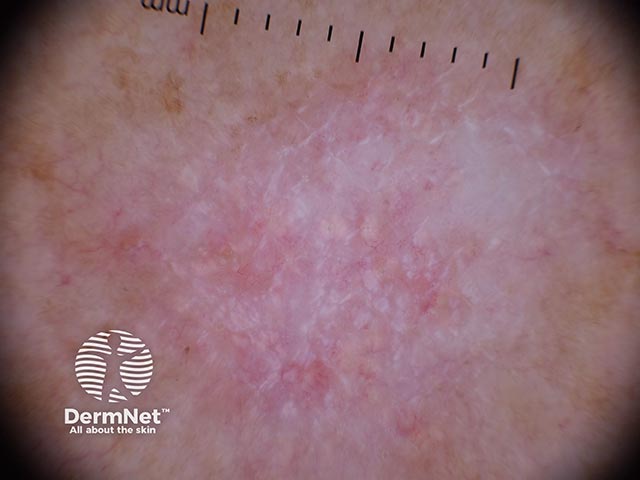 Дерматоскопия: белые бесструктурные зоны и тонкие линейные сосуды