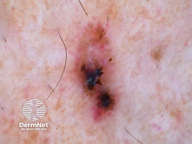 Дерматоскопия БКР кожи ноги: участки гиперпигментации и розовые зоны