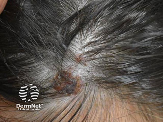 Базальноклеточный рак волосистой части головы: клинические признаки частично скрыты под коркой