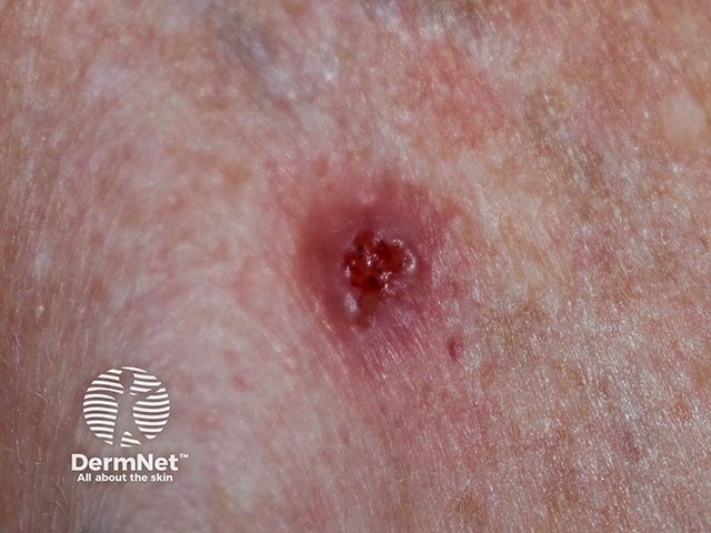 Изъязвленный базальноклеточный рак: валикообразный приподнятый край с перламутровым блеском
