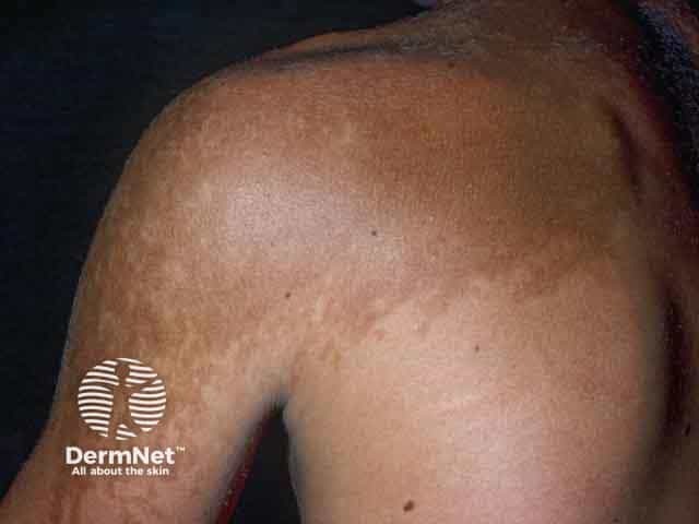 Пигментация и гипертрихоз в области плеча при невусе Беккера