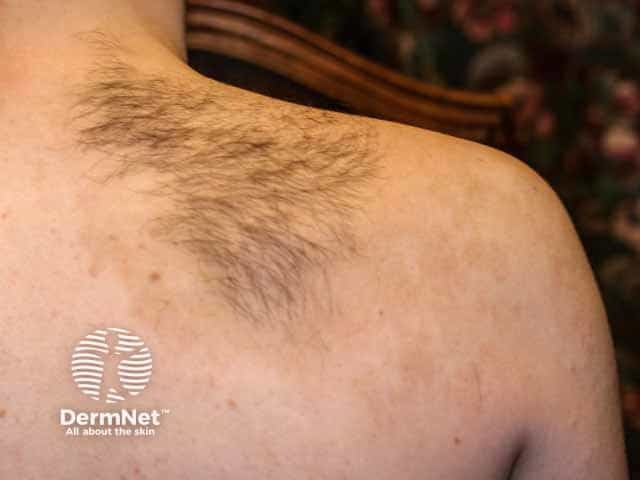 Пигментация и гипертрихоз верхней части спины при невусе Беккера