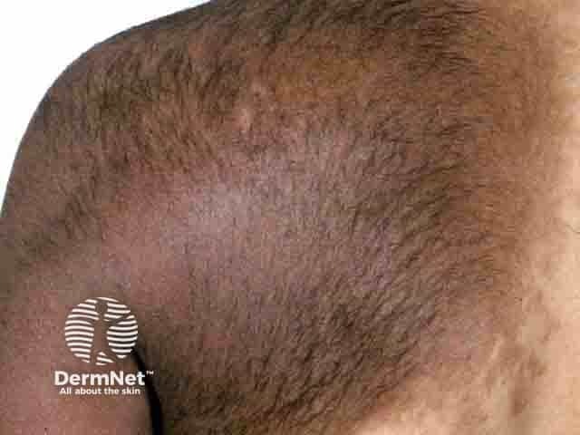 Пигментация и гипертрихоз в области плеча при невусе Беккера