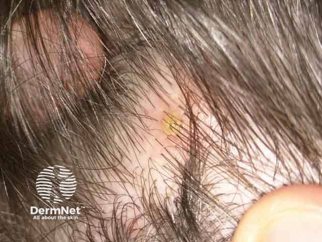 Пустула на волосистой части головы при болезни Бехчета
