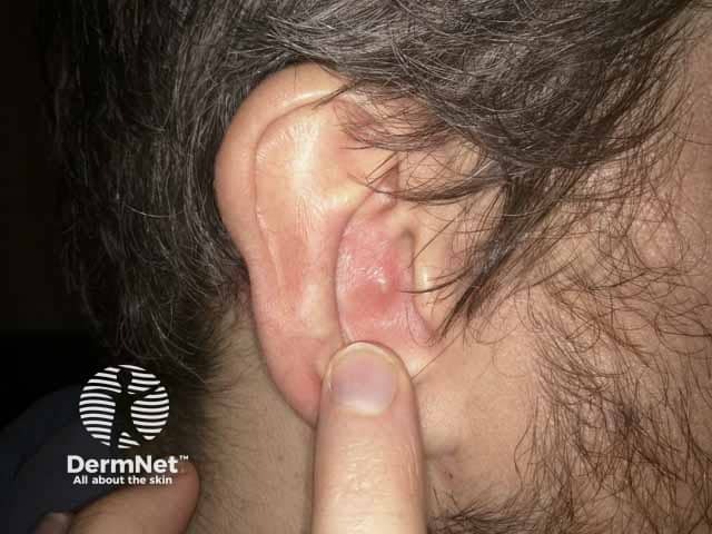 Пустулезный элемент в полости ушной раковины при болезни Бехчета