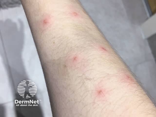 Положительный тест патергии