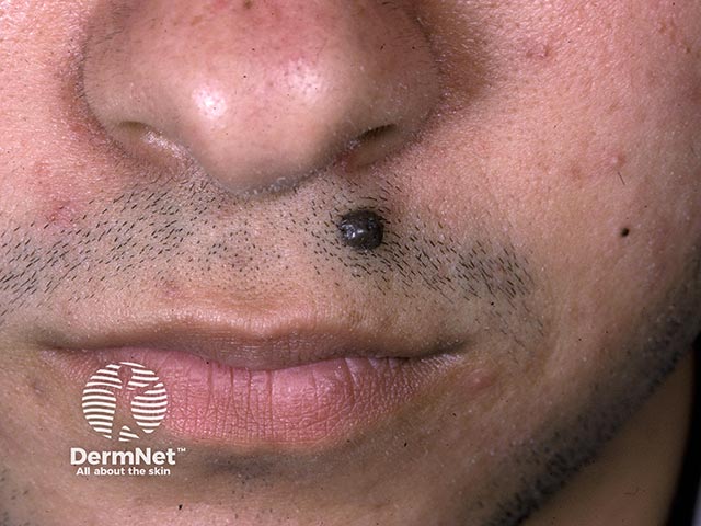 Голубой невус в области верхней губы
