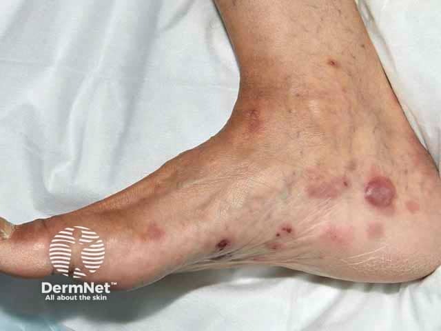 Пузыри при буллезном пемфигоиде на стопе, темный фототип кожи