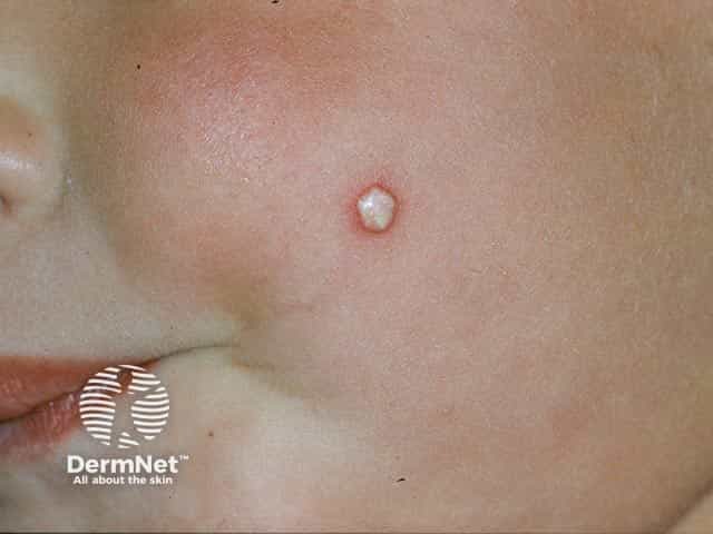Типичный меловидно-белый вид субэпидермального кальцинированного узелка на щеке