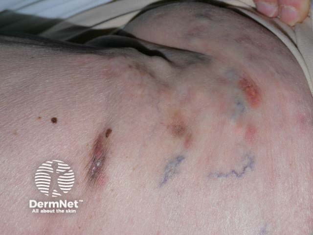 Распространенный кальциноз кожи грудной стенки на фоне дерматомиозита; местами определяются изъязвления и экструзия солей кальция