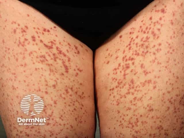 Капиллярит, индуцированный приемом амлодипина
