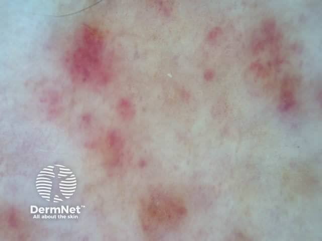 Дерматоскопическая картина капиллярита
