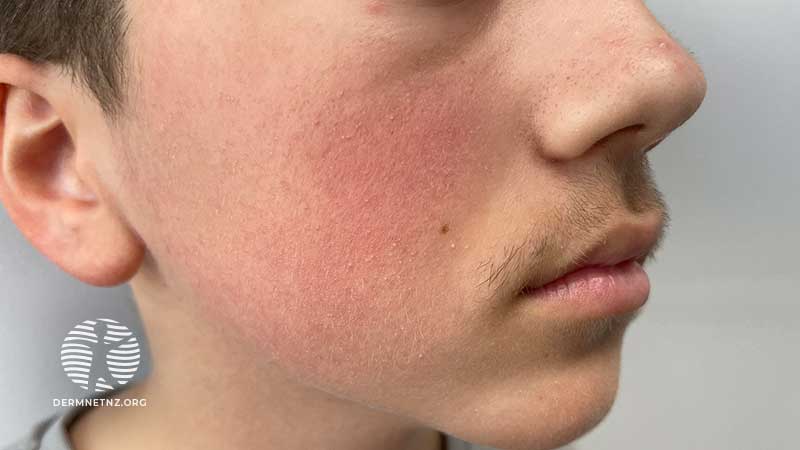 13-летний подросток с эритемой лица