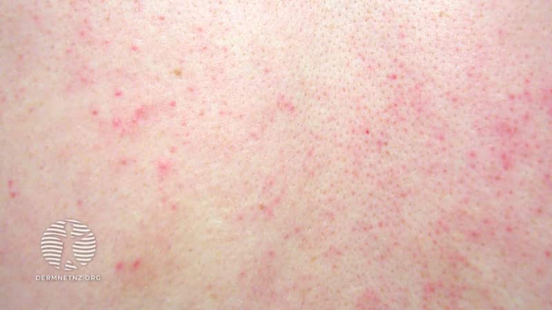 26-летняя пациентка с высыпаниями на спине