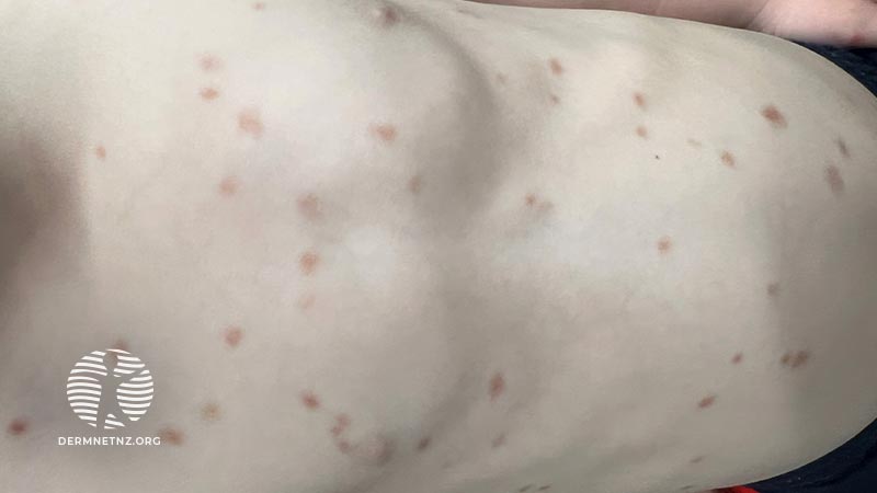 Мальчик 3 лет с гиперпигментированными высыпаниями на коже туловища