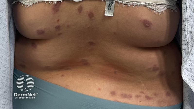 30-летний пациент с эритематозными бляшками на спине и бедрах
