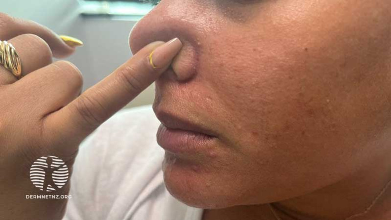 Клинический случай: 33-year-old with pink scaly facial papules