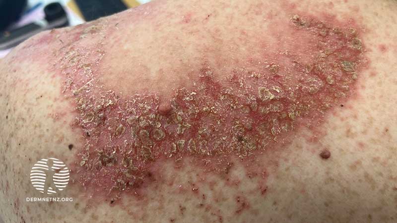 Пациентка 40 лет с хроническими корковыми высыпаниями на коже