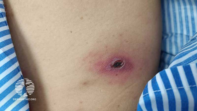 Пациентка 43 лет с зудящим элементом на коже бедра