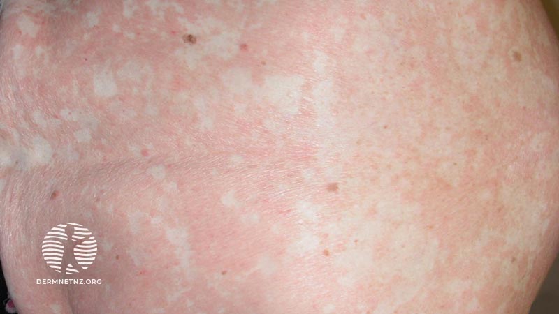 Клинический случай: 50-year-old lady with erythroderma