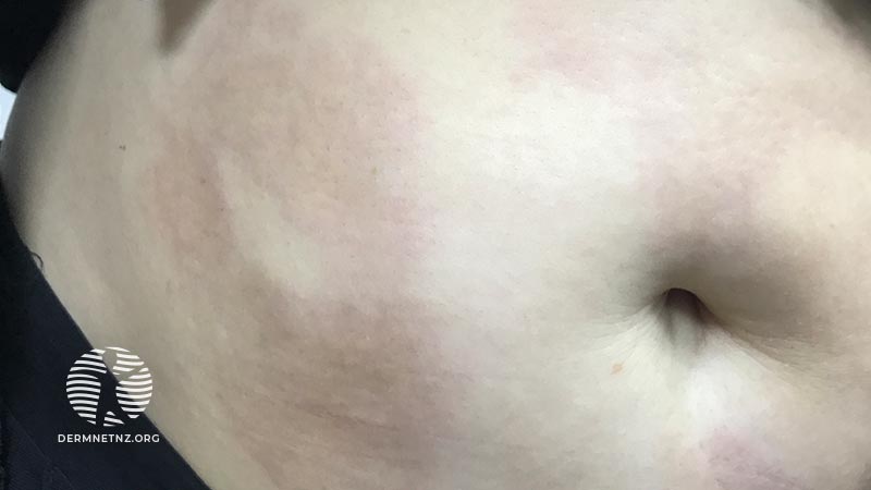 52-летняя пациентка с увеличивающимися бляшками на коже живота