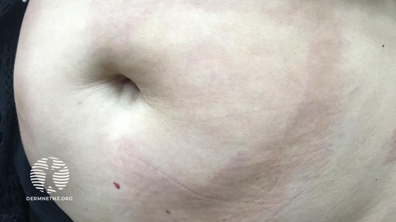 Клинический случай: 52-year-old with expanding abdominal plaques