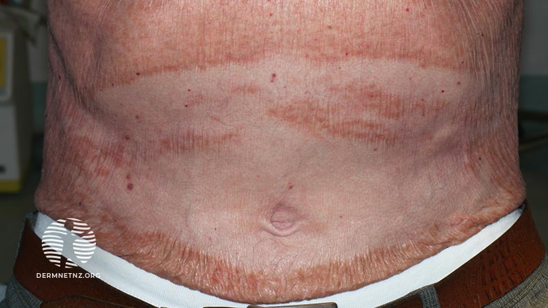 Клинический случай: 58-year-old with steroid-resistant erythroderma
