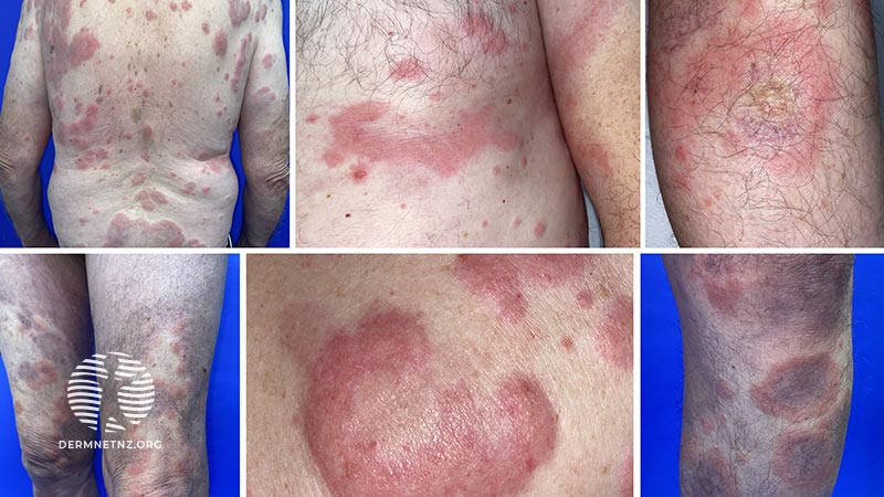 65-летний пациент с распространенной полиморфной сыпью