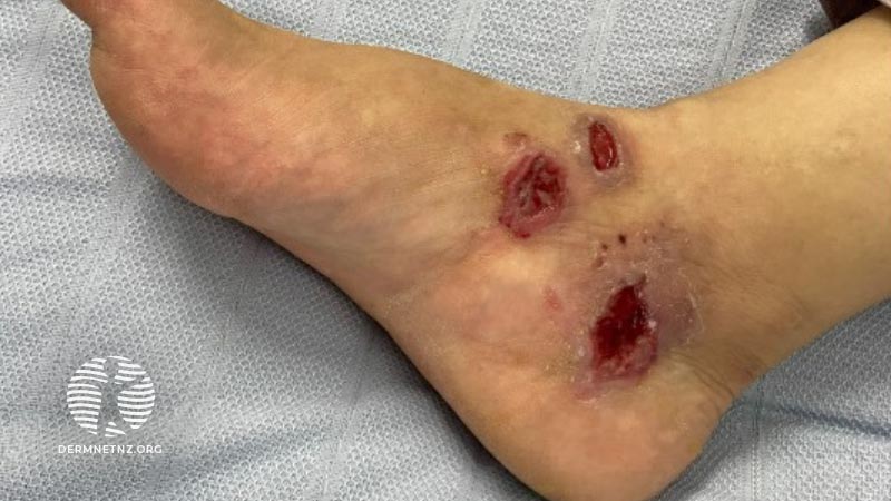 Клинический случай: An Afghan female with painful ulcers