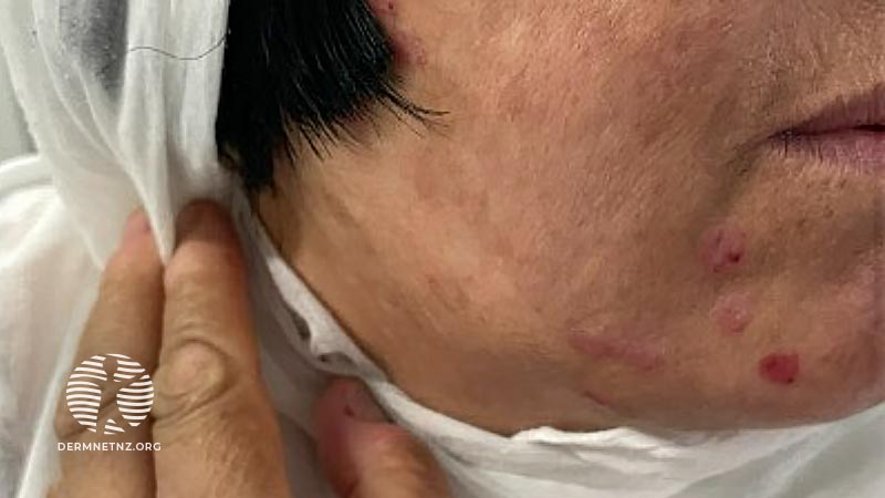 Клинический случай: An Afghan female with painful ulcers