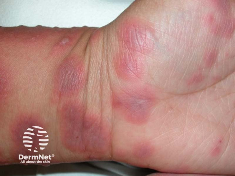 Клинический случай: Circular lesions spreading up the hands
