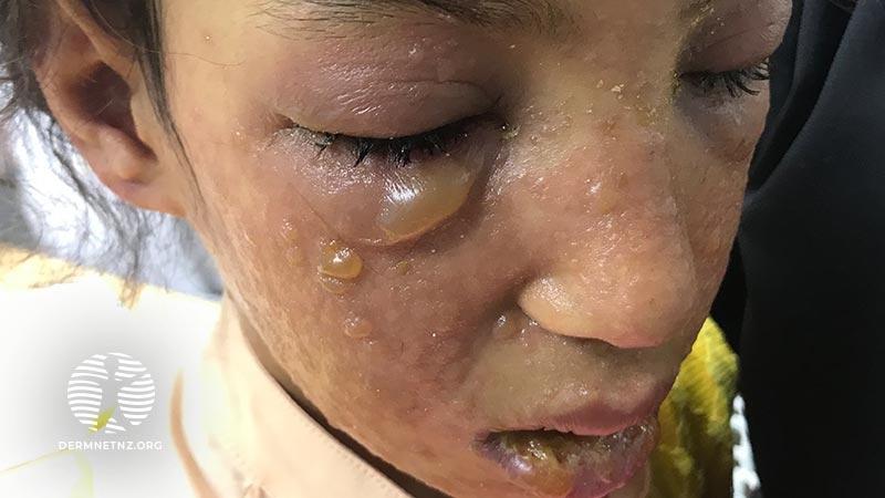 Диссеминированные пузырные высыпания у 11-летней девочки