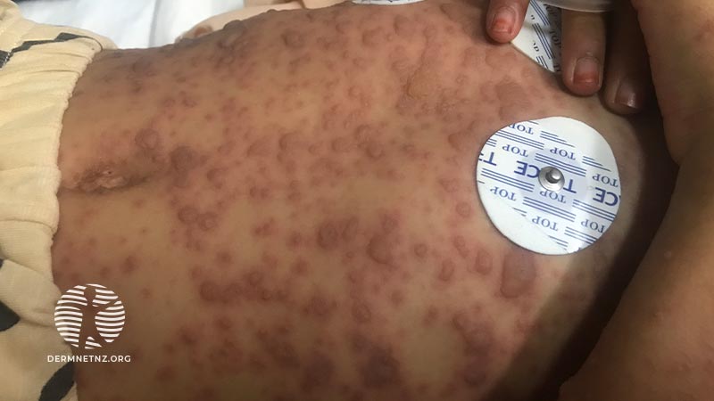 Клинический случай: Disseminated blisters in an 11-year-old