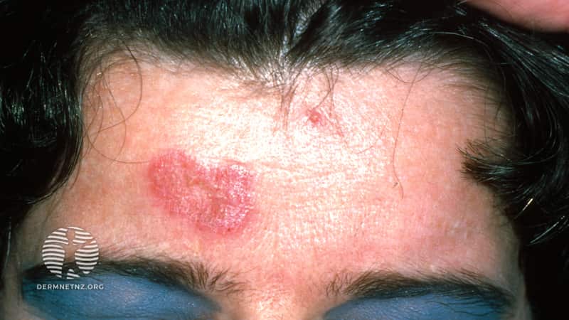Женщина с медленно распространяющейся бляшкой на лбу