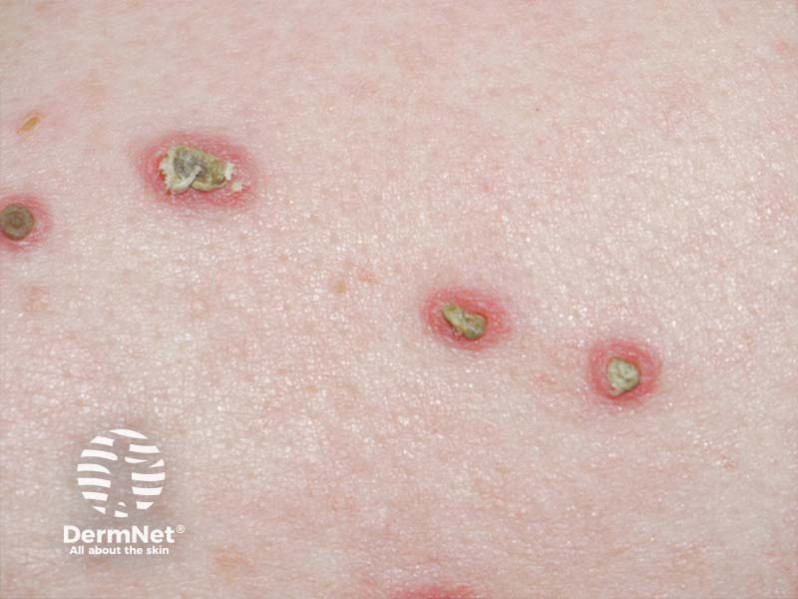 Зудящие папулы у пациента с сахарным диабетом