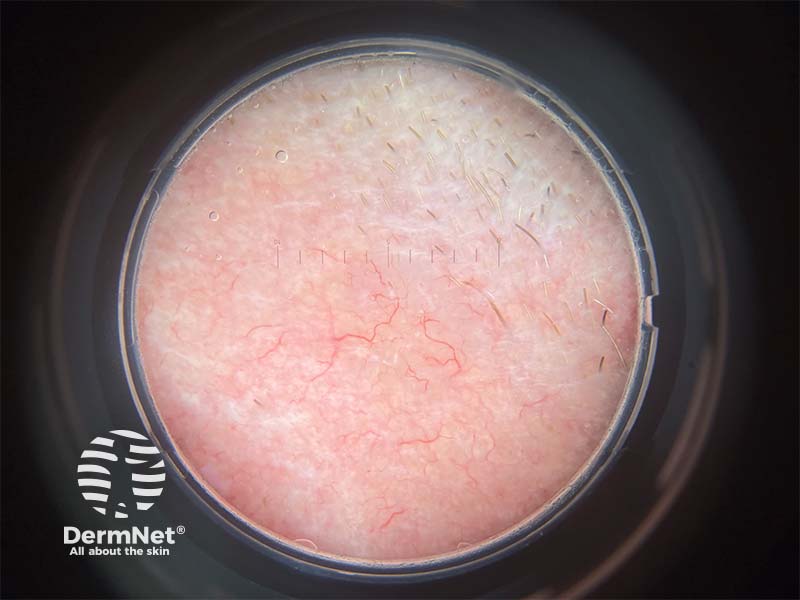 Клинический случай: Lesion on the nasolabial fold
